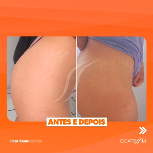 Antes e Depois Cicatrissim 4